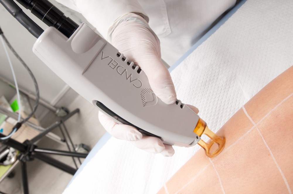 Alexandrit-Laser-Haarentfernung