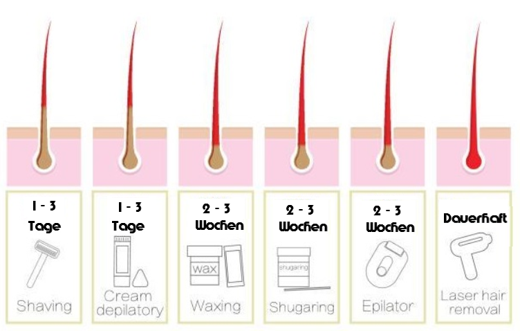 Ist die Laser-Haarentfernung dauerhaft