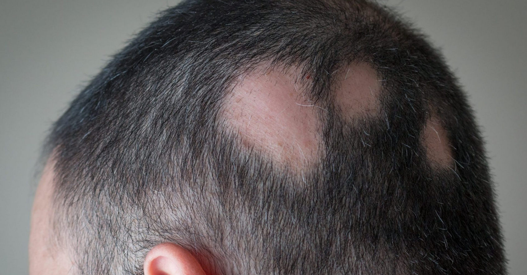 Alopecia areata