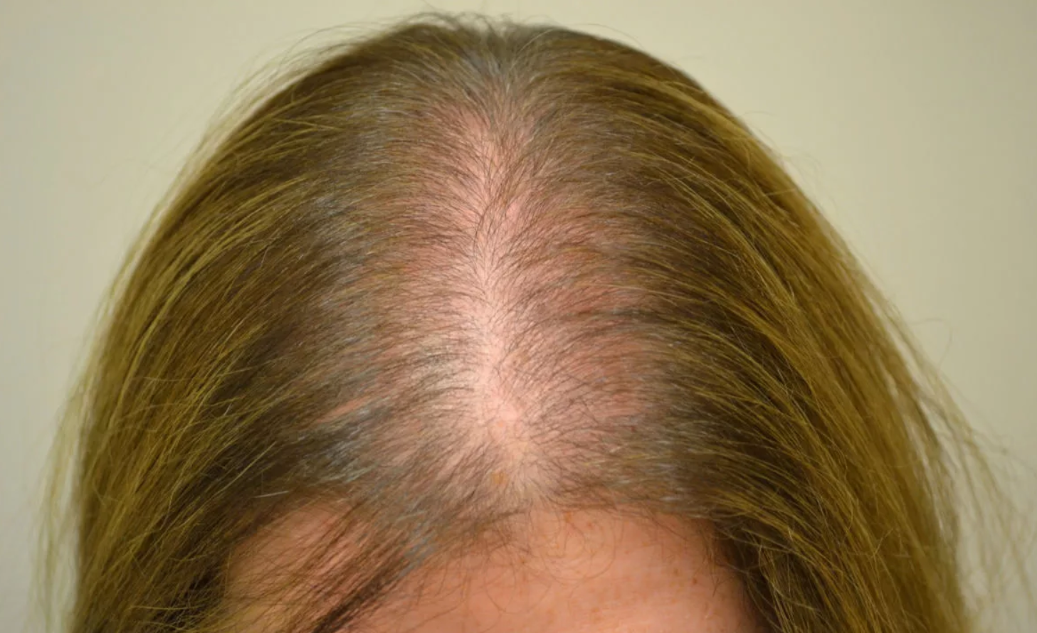 Haarausfall bei Frauen