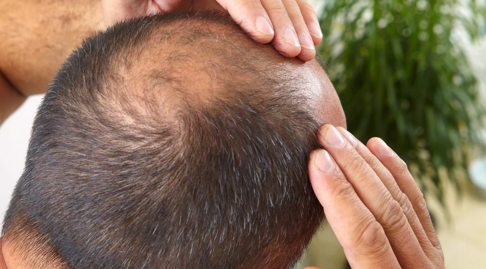 Männlich bedingter Haarausfall