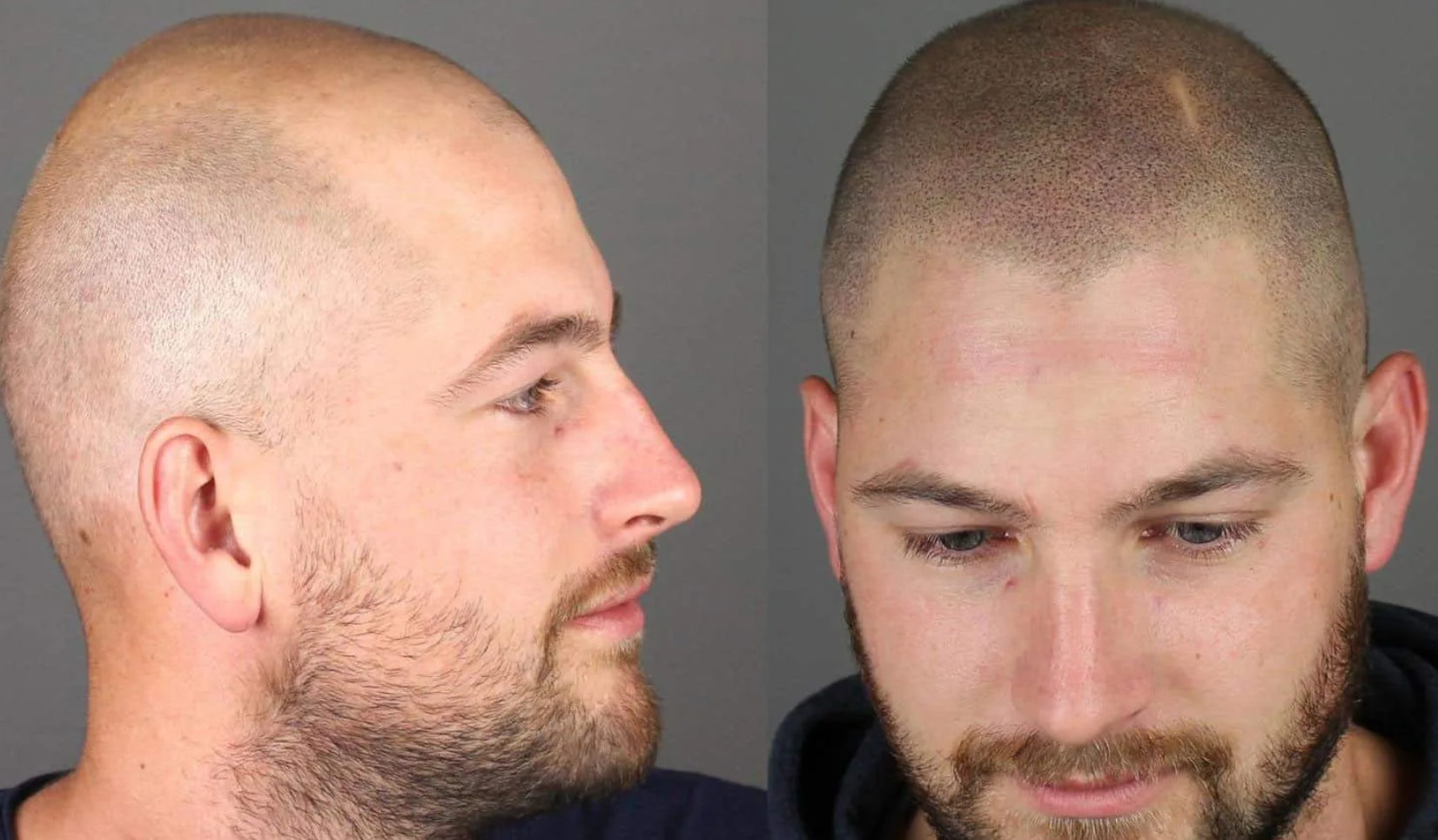 Was ist Kopfhaut-Mikropigmentierung