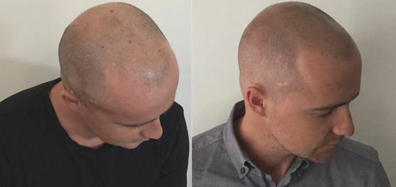 Wie wirkt die Mikropigmentierung der Kopfhaut gegen Haarausfall?