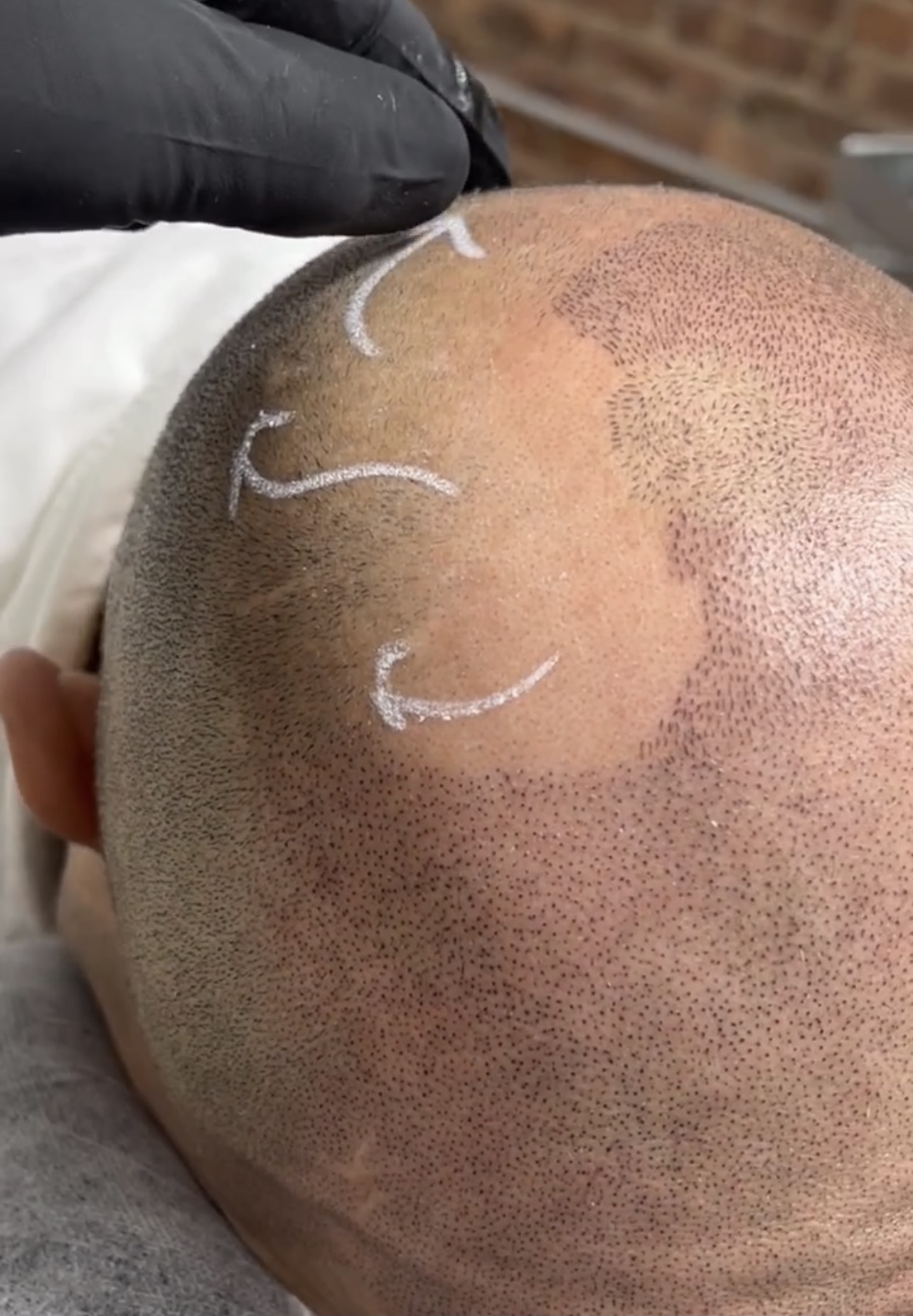 Die Micro Hair Pigmentation, auch bekannt als Scalp Micro Pigmentation, ist eine effektive Methode zur optischen Haarverdichtung. 